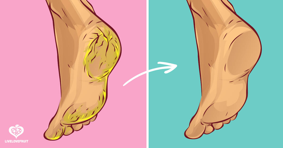 GRANDMA TOLD ME THIS TRICK. IT HEALED MY CRACKED HEELS IN JUST 1 NIGHT!!!