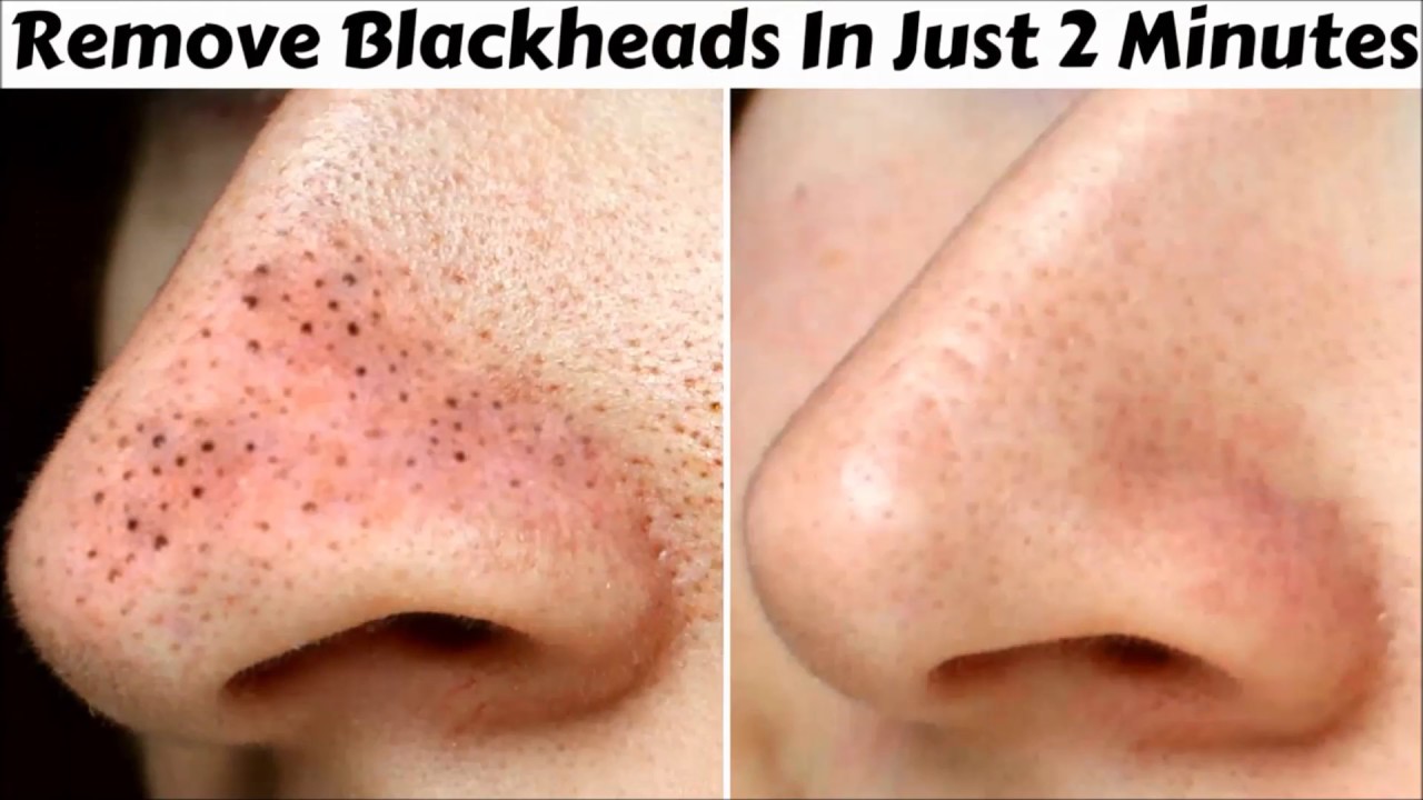 Remove Blackheads With One Simple And Effective Trick